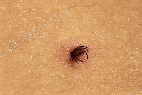 Biosphoto | 2457546 | Tick (Ixodes ricinus) biting a human, Territoire de Belfort, France | &copy; Denis Bringard / Biosphoto